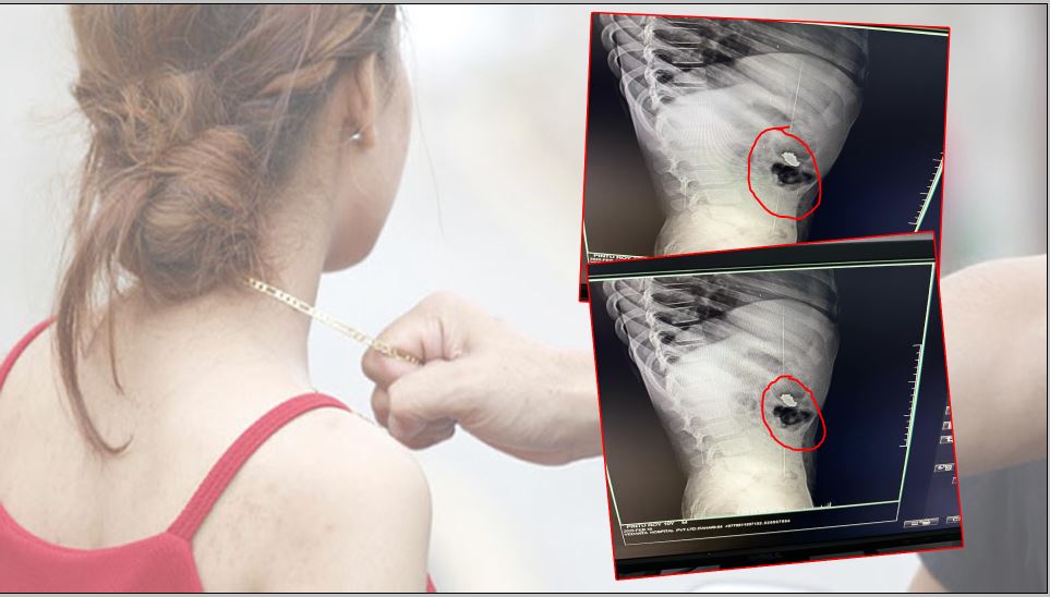 इटहरीमा अनौठो चोरी काण्ड ! लुटिएको सुन बालकको पेटमा !